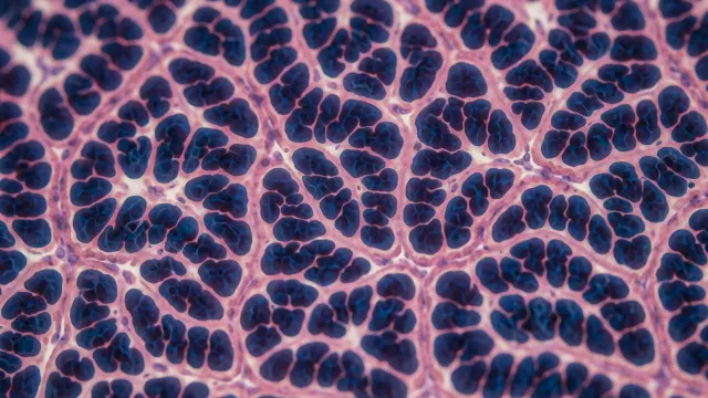 Cystic fibrosis: Triple therapy is particularly effective in early childhood